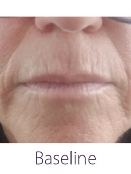 OPUS/CLEARLIFT TREATMENT