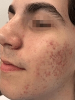 OPUS-ACNE SCARRING