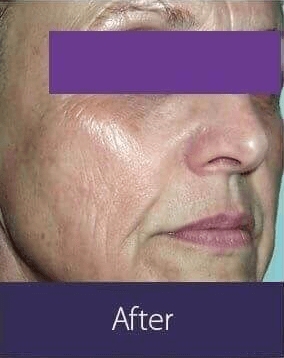 HARMONY LASER TREATMENT