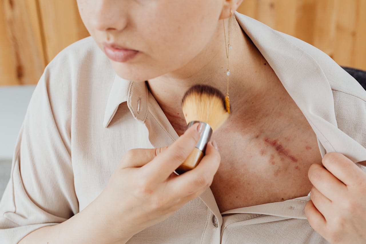 Cost of Acne Scar Removal in Utah: What to Expect