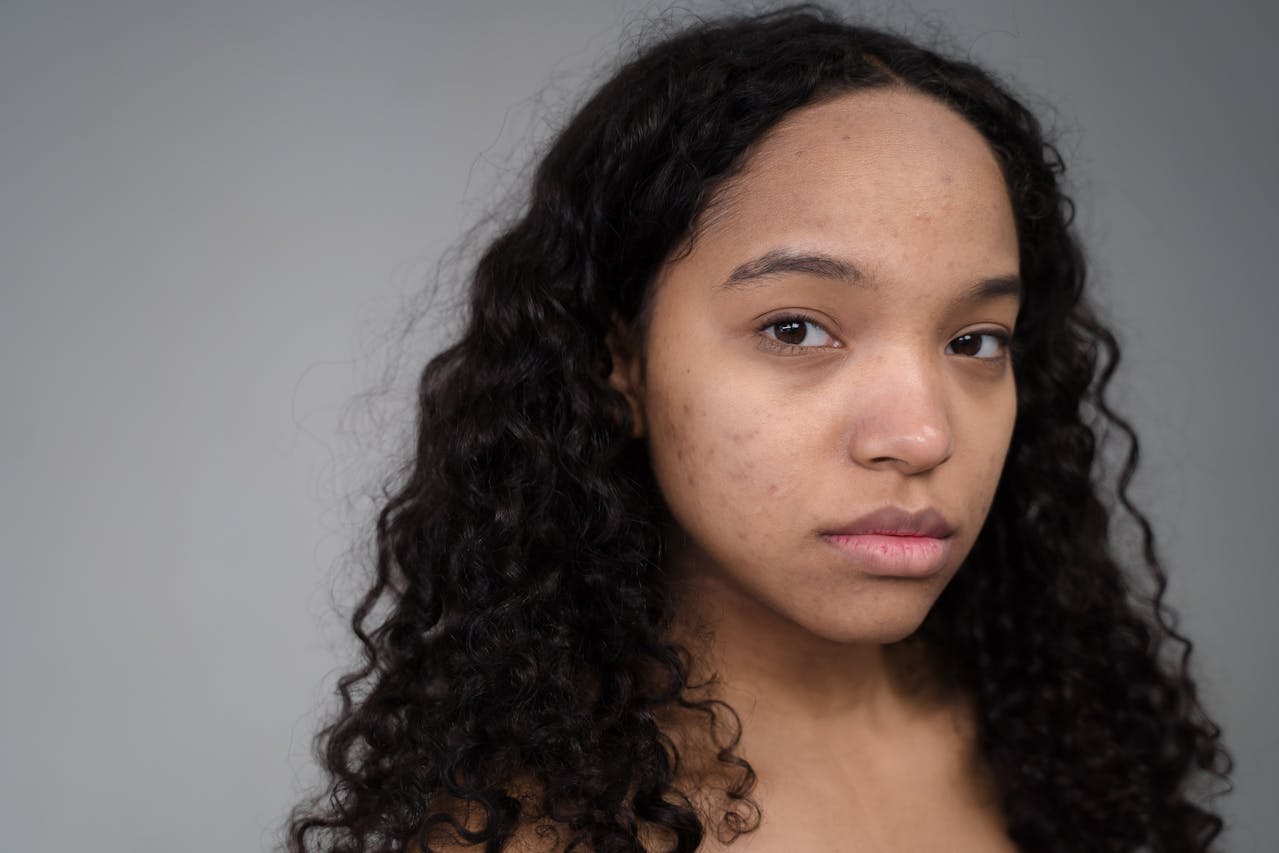 Acne Scar Removal Laser in American Fork with NuVida Aesthetics and Wellness